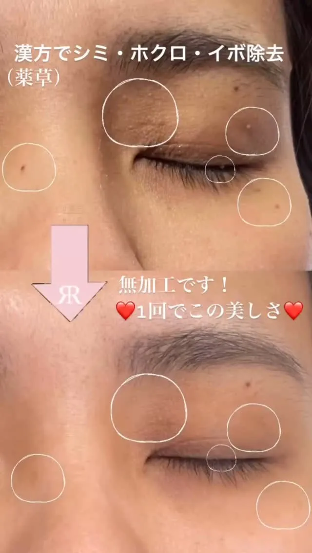 ホクロ・イボ除去しませんか？