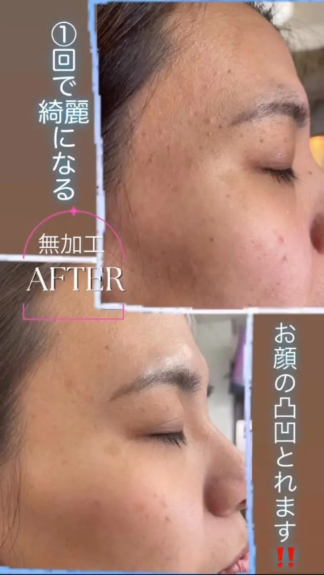 お顔の凸凹取りませんか？